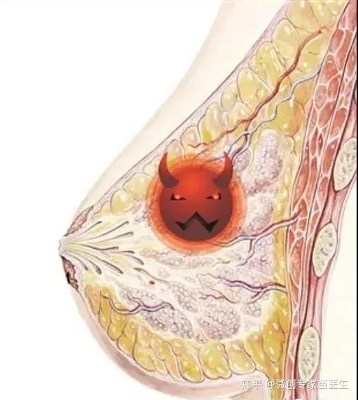 女性乳腺疾病(女性乳腺疾病是怎么造成的)