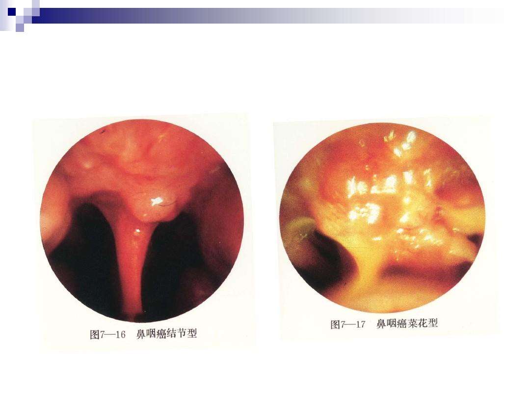 咽喉疾病(耳鼻咽喉疾病)