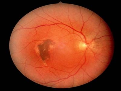 视网膜疾病(缺血性视网膜疾病)