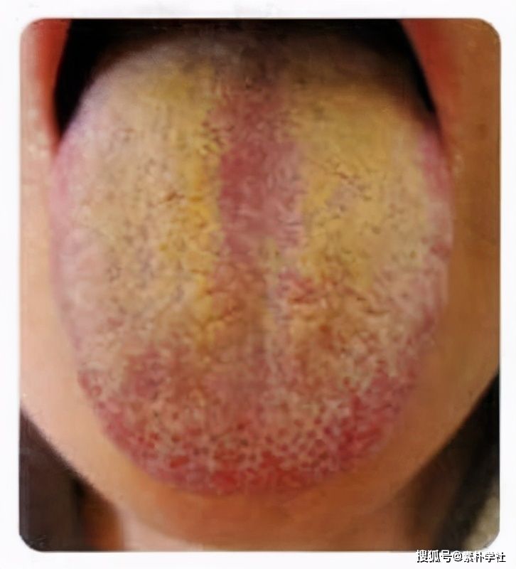 舌苔与疾病(舌苔与疾病对照图)