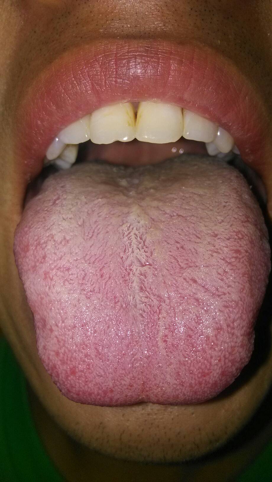舌苔与疾病(舌苔与疾病对照图)