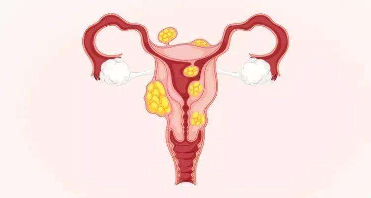 女性生殖系统疾病(女性生殖系统疾病的诊断,拍摄骨盆平片的意义是)