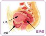 宫颈疾病症状(宫颈疾病症状图片)