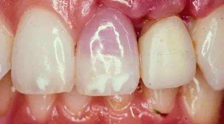 牙齿疾病有哪些(牙齿疾病有哪些?)