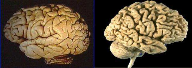 大脑疾病(大脑疾病怎么检查)