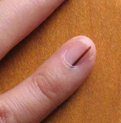 指甲与疾病(指甲和身体疾病)