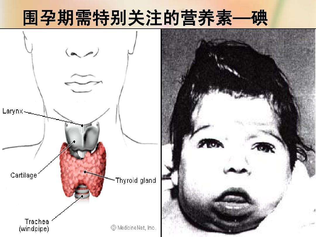 缺碘会导致哪种疾病(严重缺碘会导致哪种疾病)