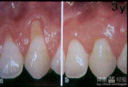牙龈疾病(牙龈疾病挂什么科?)