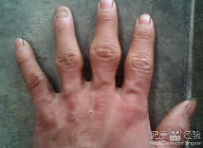 手指疾病(手指疾病去医院哪个门诊)